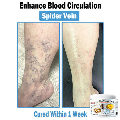 Improvement within 7 days ⏰𝐃𝐨𝐫𝐦𝐨𝐫𝐧𝐚™🌲𝑩𝒆𝒆 𝑽𝒆𝒏𝒐𝒎 𝑴𝒖𝒍𝒕𝒊-𝑺𝒚𝒎𝒑𝒕𝒐𝒎 𝑺𝒌𝒊𝒏 𝑻𝒓𝒆𝒂𝒕𝒎𝒆𝒏𝒕 𝑪𝒓𝒆𝒂𝒎 (👨‍⚕ Recommended by the ADA) (Clears acne, warts, rosacea, psoriasis, age spots, eczema, and improves skin sagging)