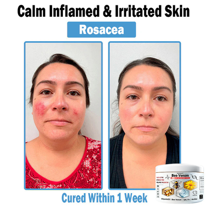 Improvement within 7 days ⏰𝐃𝐨𝐫𝐦𝐨𝐫𝐧𝐚™🌲𝑩𝒆𝒆 𝑽𝒆𝒏𝒐𝒎 𝑴𝒖𝒍𝒕𝒊-𝑺𝒚𝒎𝒑𝒕𝒐𝒎 𝑺𝒌𝒊𝒏 𝑻𝒓𝒆𝒂𝒕𝒎𝒆𝒏𝒕 𝑪𝒓𝒆𝒂𝒎 (👨‍⚕ Recommended by the ADA) (Clears acne, warts, rosacea, psoriasis, age spots, eczema, and improves skin sagging)
